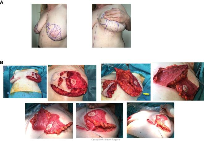 https://cdn.ncbi.nlm.nih.gov/pmc/blobs/bd77/10338173/e249c5db64d5/fonc-13-1176915-g004.jpg