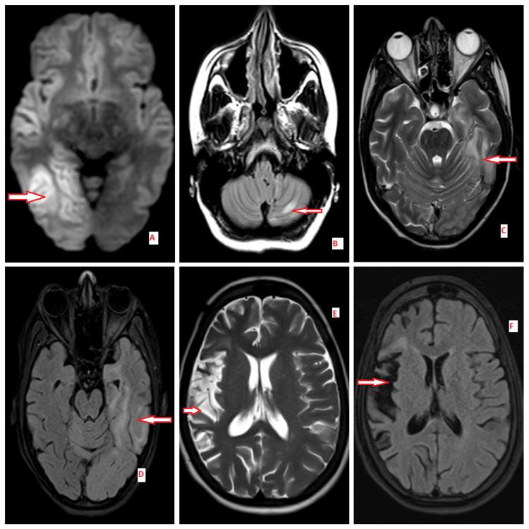 https://cdn.ncbi.nlm.nih.gov/pmc/blobs/bd79/12083851/010c51202cf4/cureus-0017-00000082384-i01.jpg