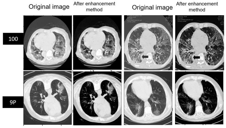 https://cdn.ncbi.nlm.nih.gov/pmc/blobs/bd89/10178408/807c06c4fbf0/diagnostics-13-01658-g007.jpg
