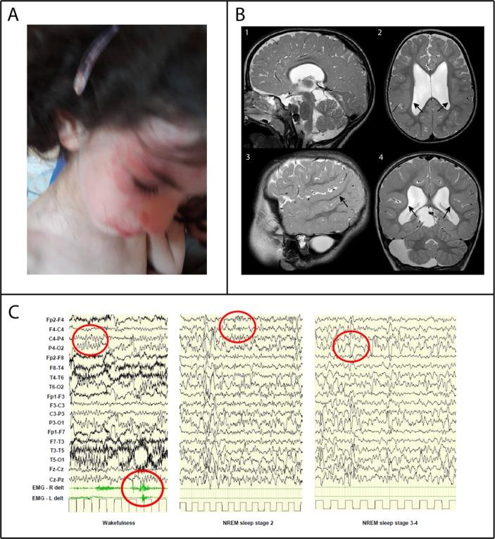 https://cdn.ncbi.nlm.nih.gov/pmc/blobs/bdbf/5869459/1311f6e67fa5/jmedgenet-2017-105125f01.jpg