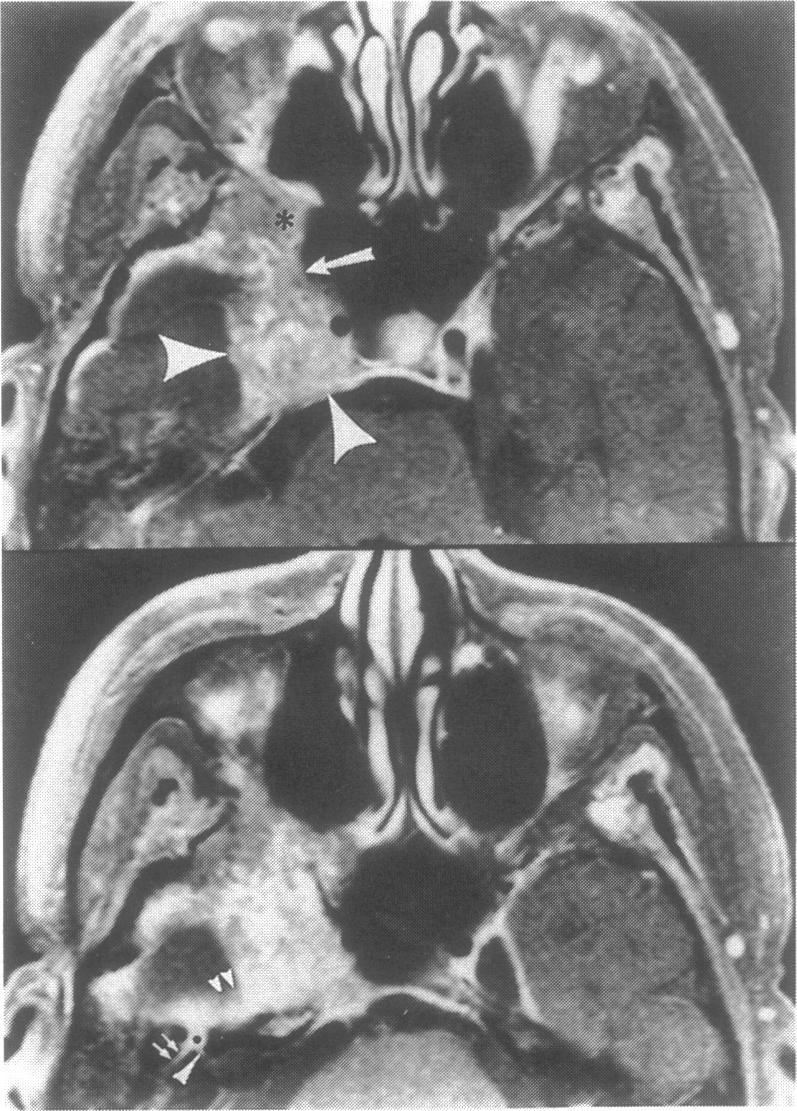 https://cdn.ncbi.nlm.nih.gov/pmc/blobs/bde3/1656665/02187cff6867/skullbasesurg00010-0045-b.jpg