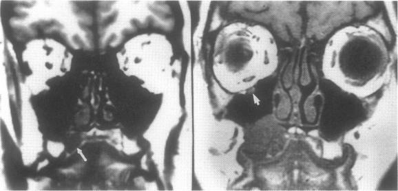 https://cdn.ncbi.nlm.nih.gov/pmc/blobs/bde3/1656665/1dabdd4d6770/skullbasesurg00010-0045-a.jpg