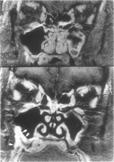 https://cdn.ncbi.nlm.nih.gov/pmc/blobs/bde3/1656665/600e72853eb8/skullbasesurg00010-0043-b.jpg