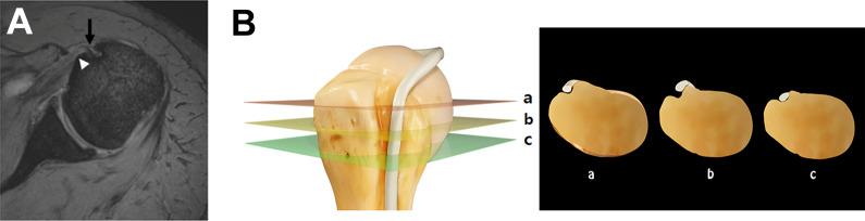 https://cdn.ncbi.nlm.nih.gov/pmc/blobs/be02/7333499/a1677c227dc2/10.1177_2325967119898123-fig2.jpg