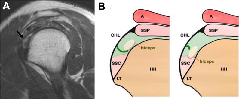 https://cdn.ncbi.nlm.nih.gov/pmc/blobs/be02/7333499/e37723363ddc/10.1177_2325967119898123-fig1.jpg