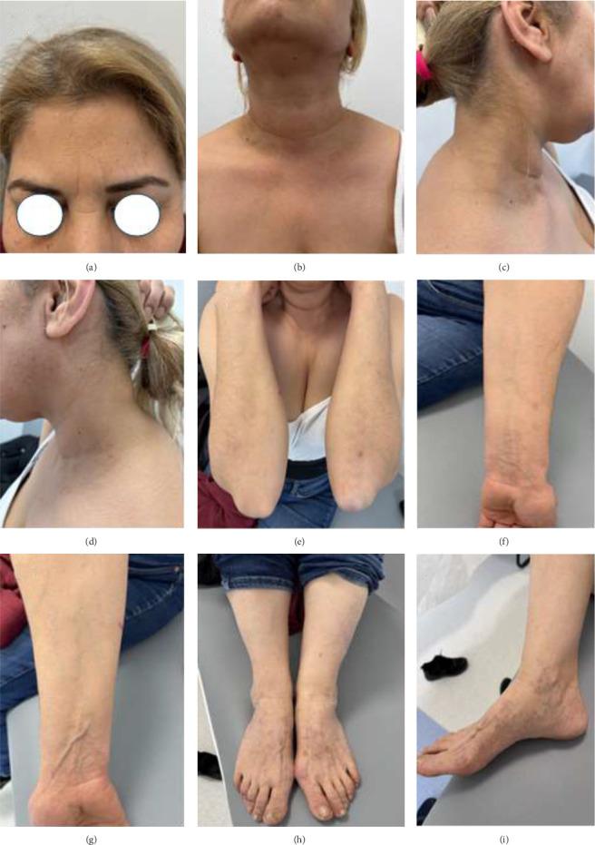 https://cdn.ncbi.nlm.nih.gov/pmc/blobs/be3d/12349983/32997b0ab678/CRIM2025-6883705.004.jpg