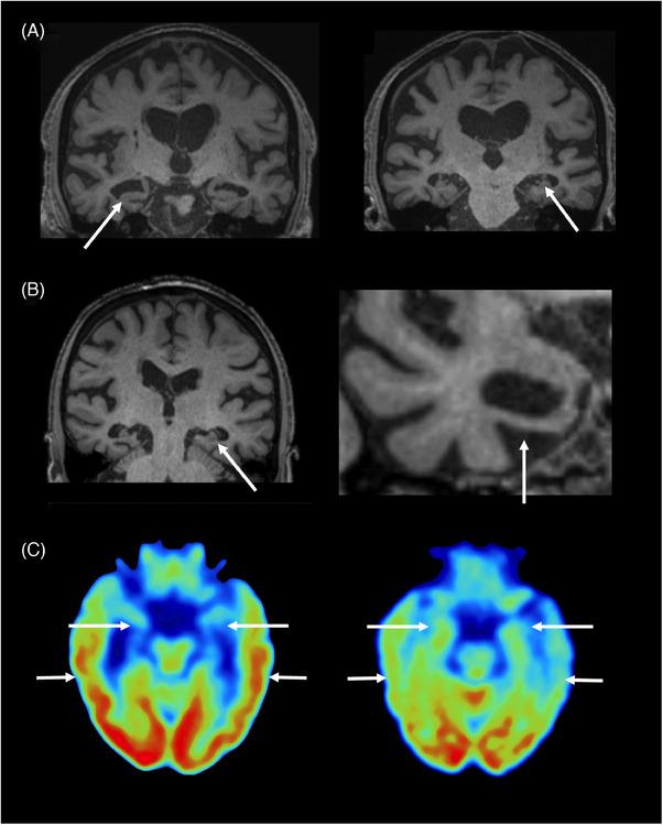 https://cdn.ncbi.nlm.nih.gov/pmc/blobs/be56/11772733/e2d058d91899/ALZ-21-e14202-g002.jpg