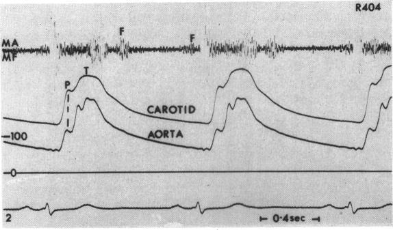 https://cdn.ncbi.nlm.nih.gov/pmc/blobs/be65/1018163/9dccb593487a/brheartj00345-0018-a.jpg