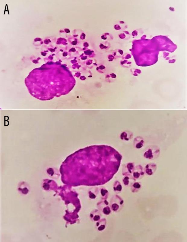 https://cdn.ncbi.nlm.nih.gov/pmc/blobs/be6b/11322791/f83b4992f15a/amjcaserep-25-e944422-g003.jpg