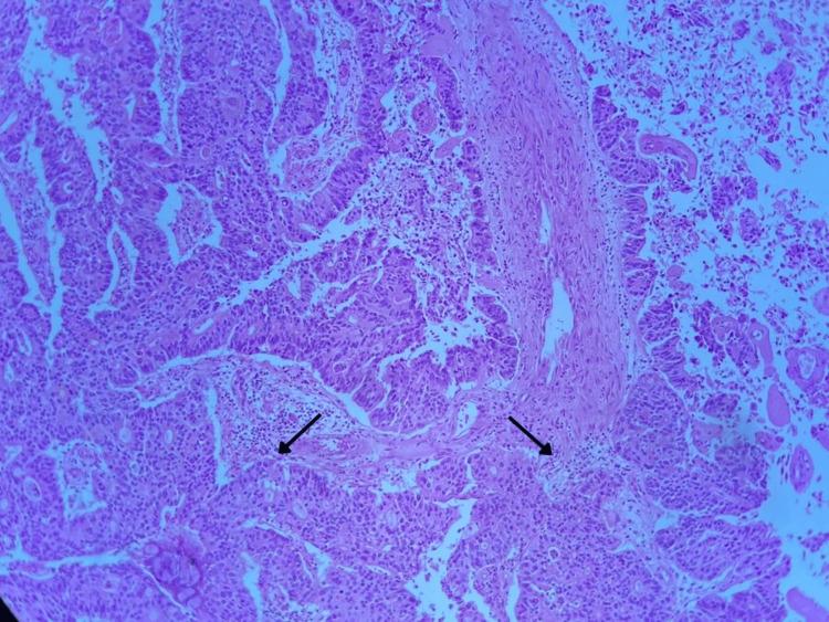 https://cdn.ncbi.nlm.nih.gov/pmc/blobs/be75/11164558/5feb140fecc9/cureus-0016-00000060106-i01.jpg