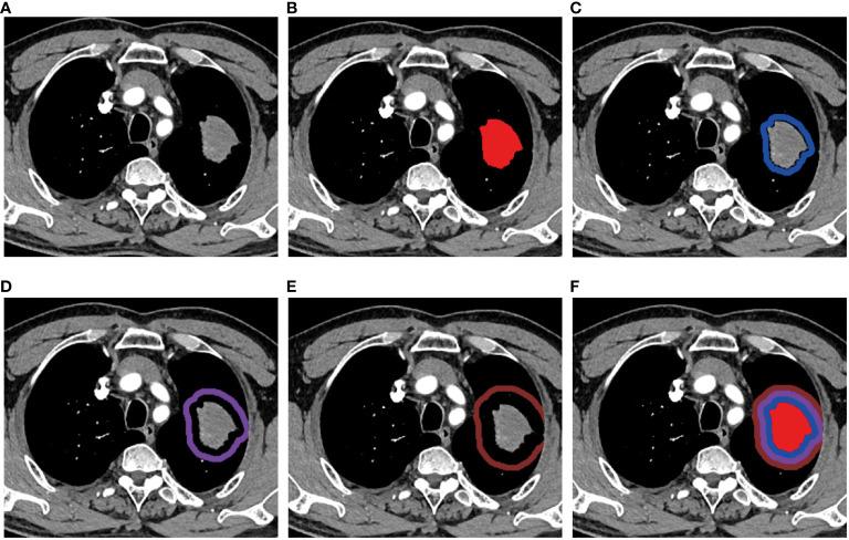https://cdn.ncbi.nlm.nih.gov/pmc/blobs/bebc/10996281/36e08d36d7d8/fonc-14-1348678-g002.jpg