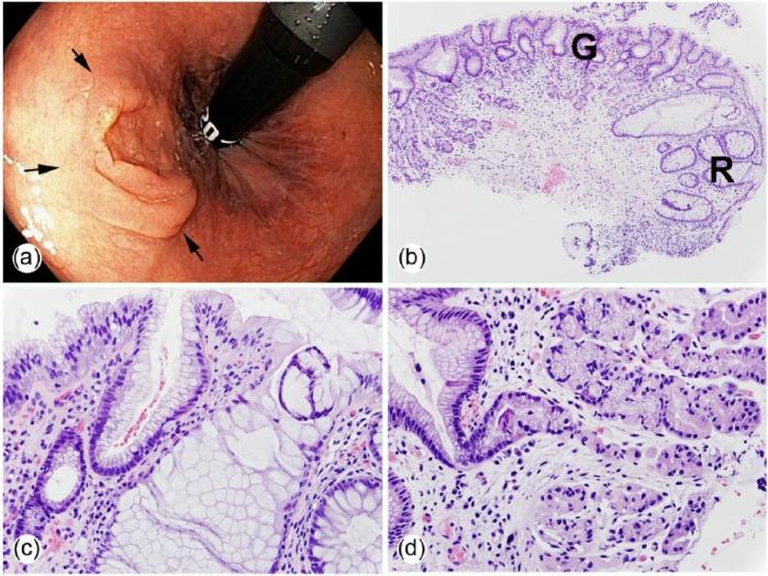 https://cdn.ncbi.nlm.nih.gov/pmc/blobs/bec5/5347492/8b80c79bb76c/10.1177_2050313X17693968-fig2.jpg