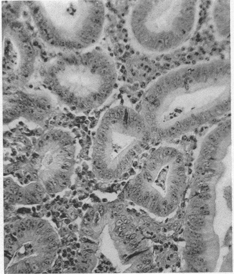 https://cdn.ncbi.nlm.nih.gov/pmc/blobs/bee0/1399891/8200d53efb4c/annsurg00714-0126-d.jpg