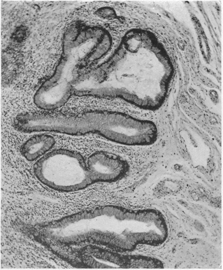 https://cdn.ncbi.nlm.nih.gov/pmc/blobs/bee0/1399891/9d8a58108be7/annsurg00714-0125-c.jpg