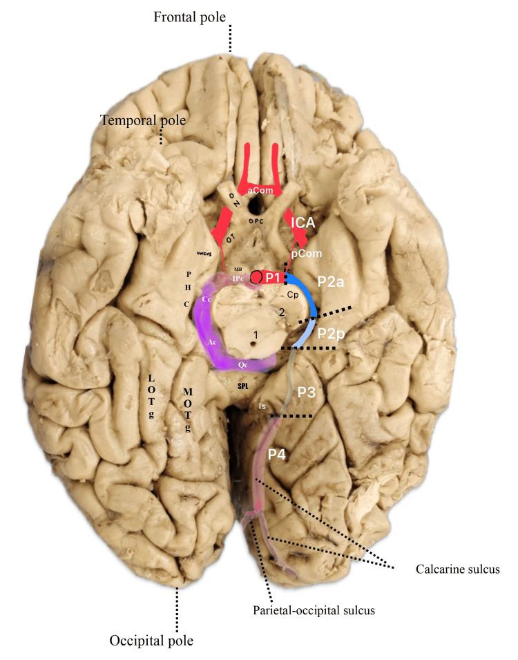 https://cdn.ncbi.nlm.nih.gov/pmc/blobs/bf4a/12025352/71893cbcfac8/cureus-0017-00000081205-i01.jpg