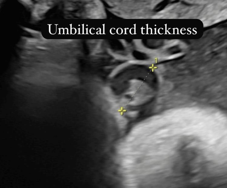 https://cdn.ncbi.nlm.nih.gov/pmc/blobs/bf58/12168813/0a84361b2b69/cureus-0017-00000084198-i03.jpg