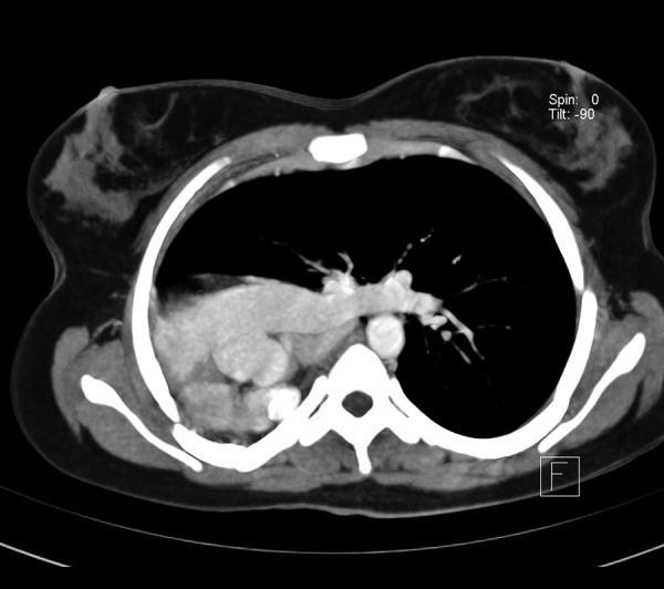https://cdn.ncbi.nlm.nih.gov/pmc/blobs/bf75/4324577/e4b0d8fe8a1d/amjcaserep-16-69-g002.jpg