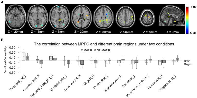 https://cdn.ncbi.nlm.nih.gov/pmc/blobs/bfab/10237040/e3a4f28e6b3a/fneur-14-1102335-g006.jpg