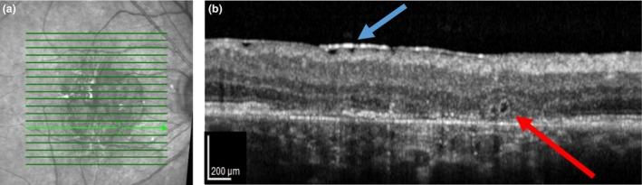 https://cdn.ncbi.nlm.nih.gov/pmc/blobs/bfc4/7155023/38357bac903a/OPO-40-88-g007.jpg
