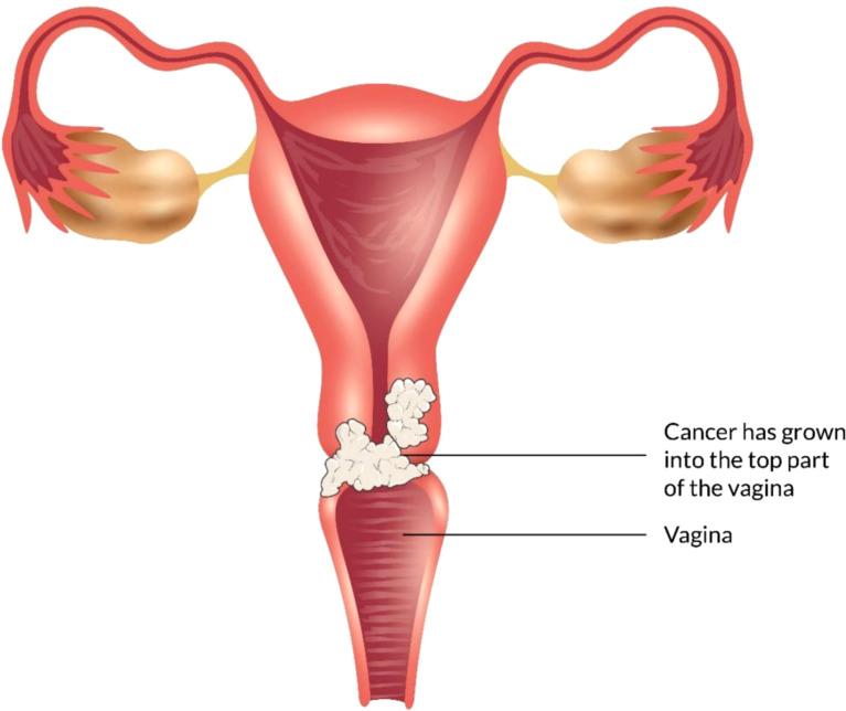 https://cdn.ncbi.nlm.nih.gov/pmc/blobs/bfc6/9341270/45ee7ad897f4/fonc-12-883805-g005.jpg