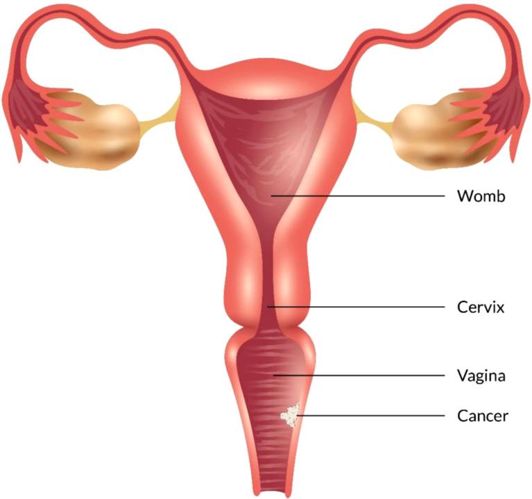 https://cdn.ncbi.nlm.nih.gov/pmc/blobs/bfc6/9341270/8b1e308a5824/fonc-12-883805-g004.jpg
