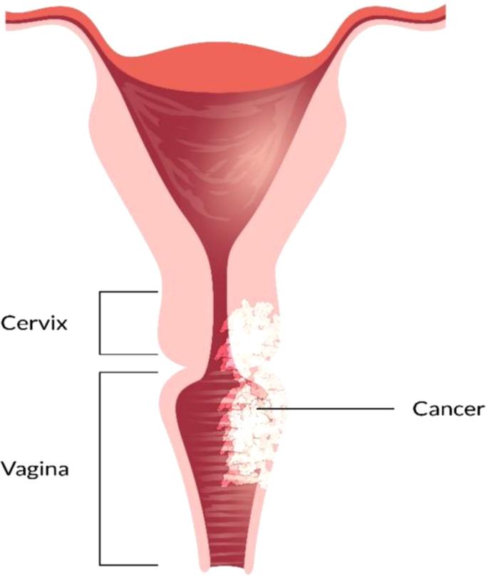 https://cdn.ncbi.nlm.nih.gov/pmc/blobs/bfc6/9341270/92a215d5f698/fonc-12-883805-g006.jpg