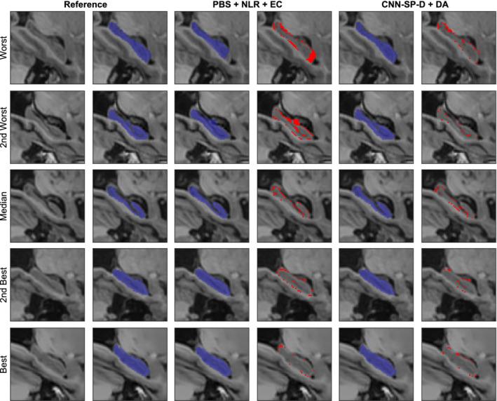 https://cdn.ncbi.nlm.nih.gov/pmc/blobs/c006/7267949/120e883b7a3b/HBM-41-309-g006.jpg