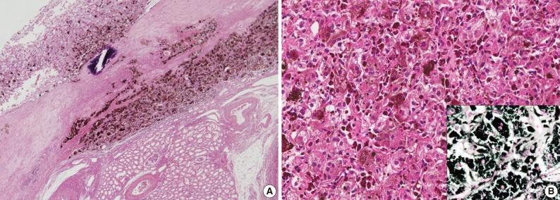 https://cdn.ncbi.nlm.nih.gov/pmc/blobs/c00f/3490117/717b78f1ef40/kjpathol-46-499-g002.jpg