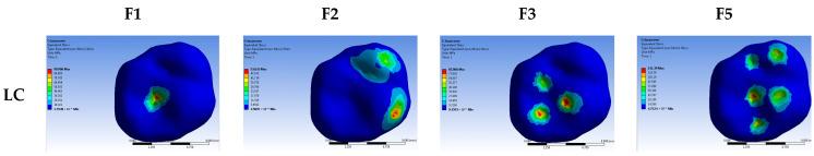 https://cdn.ncbi.nlm.nih.gov/pmc/blobs/c079/12026018/9f8dd5638433/dentistry-13-00137-g004.jpg