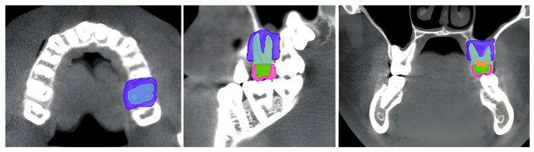 https://cdn.ncbi.nlm.nih.gov/pmc/blobs/c079/12026018/cd2573a62d35/dentistry-13-00137-g001.jpg