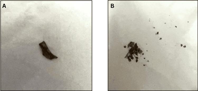 https://cdn.ncbi.nlm.nih.gov/pmc/blobs/c081/12320560/5f04daf2b229/cureus-0017-00000089327-i04.jpg