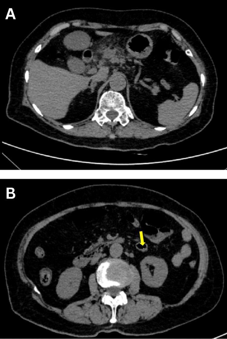 https://cdn.ncbi.nlm.nih.gov/pmc/blobs/c081/12320560/93426724fe3f/cureus-0017-00000089327-i03.jpg