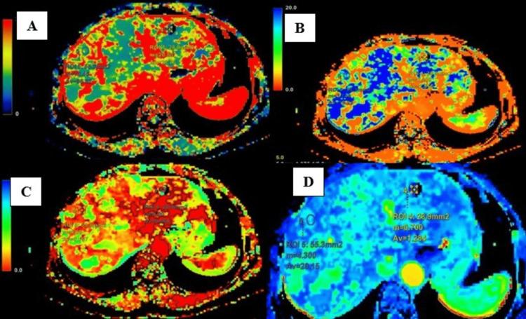 https://cdn.ncbi.nlm.nih.gov/pmc/blobs/c092/9833639/bf4e6324c8b9/cureus-0014-00000032420-i03.jpg