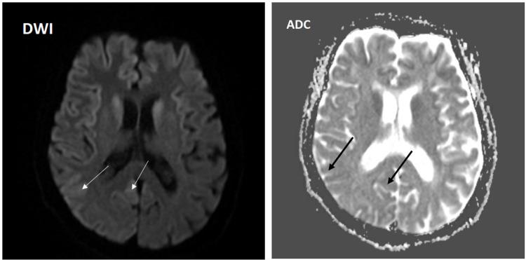 https://cdn.ncbi.nlm.nih.gov/pmc/blobs/c0f7/9012942/d8b772824d7e/cureus-0014-00000023245-i03.jpg