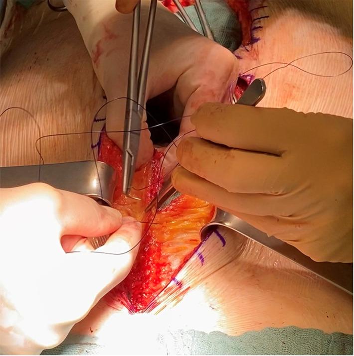 https://cdn.ncbi.nlm.nih.gov/pmc/blobs/c11e/9727106/908015dea64c/fsurg-09-1002558-i003.jpg