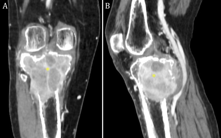 https://cdn.ncbi.nlm.nih.gov/pmc/blobs/c133/10919316/2960e7b477bb/cureus-0016-00000053717-i01.jpg