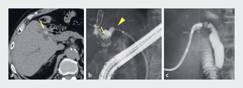 https://cdn.ncbi.nlm.nih.gov/pmc/blobs/c16d/11785430/384a7d34584b/10-1055-a-2515-3156_25162744.jpg