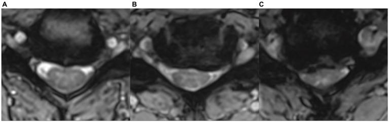 https://cdn.ncbi.nlm.nih.gov/pmc/blobs/c19c/11116587/42a08487fb0d/fneur-15-1341371-g001.jpg