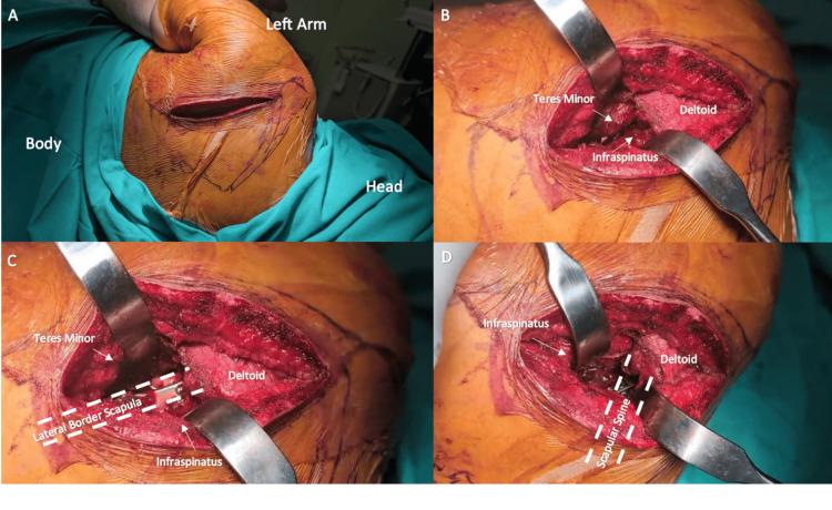 https://cdn.ncbi.nlm.nih.gov/pmc/blobs/c1cc/12368471/1099fef40542/cureus-0017-00000088478-i02.jpg
