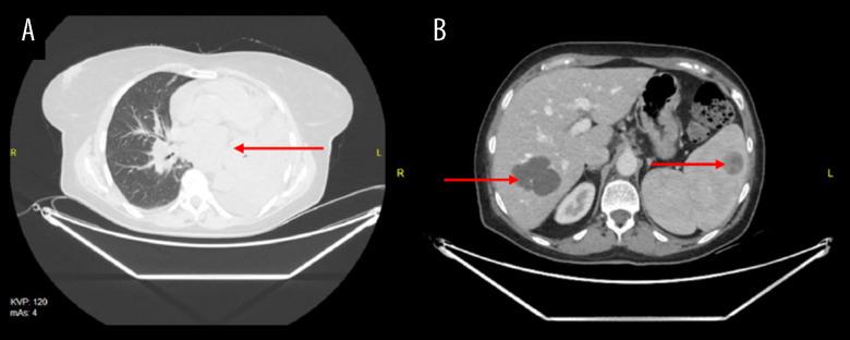 https://cdn.ncbi.nlm.nih.gov/pmc/blobs/c1cd/11193846/8ed5e7f42a2f/amjcaserep-25-e943798-g004.jpg