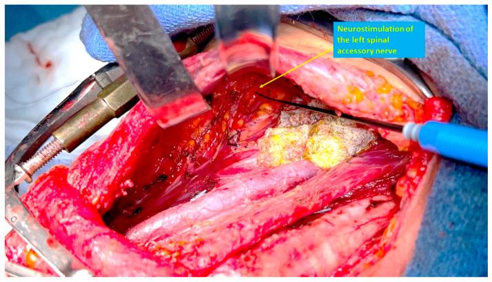 https://cdn.ncbi.nlm.nih.gov/pmc/blobs/c222/12070824/627e9c924e0c/cancers-17-01497-g003.jpg