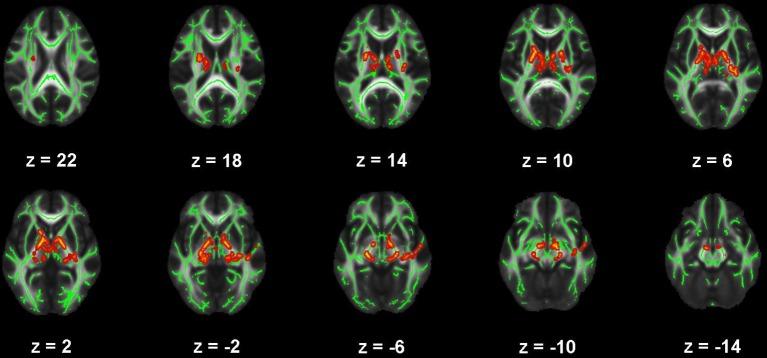 https://cdn.ncbi.nlm.nih.gov/pmc/blobs/c256/6019466/a6b829c088ec/fneur-09-00468-g0003.jpg