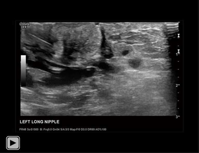 https://cdn.ncbi.nlm.nih.gov/pmc/blobs/c27a/12314676/449a6f00463c/tbcr-06-30-vid2.jpg