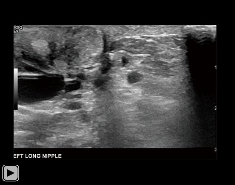 https://cdn.ncbi.nlm.nih.gov/pmc/blobs/c27a/12314676/b5e64da96614/tbcr-06-30-vid1.jpg