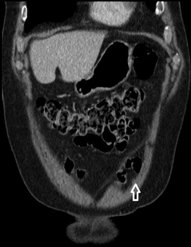 https://cdn.ncbi.nlm.nih.gov/pmc/blobs/c2cc/7068098/a163aca11307/bjrcr.20190072.g005.jpg