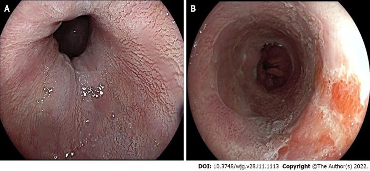 https://cdn.ncbi.nlm.nih.gov/pmc/blobs/c326/8985480/498b31375d58/WJG-28-1113-g003.jpg