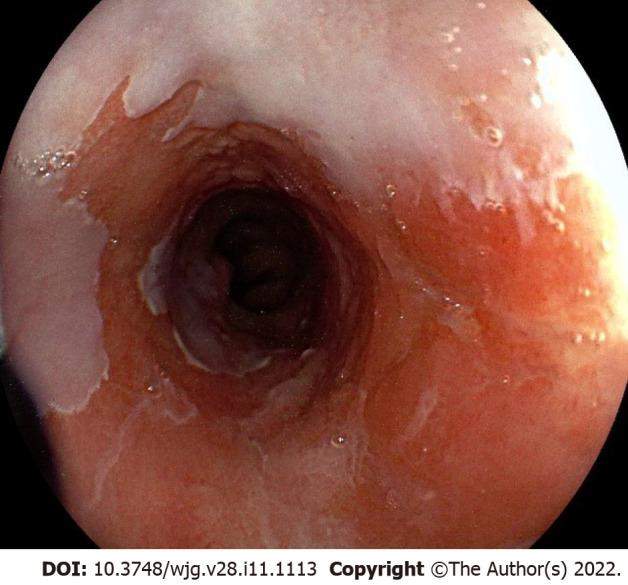 https://cdn.ncbi.nlm.nih.gov/pmc/blobs/c326/8985480/92859a43416b/WJG-28-1113-g002.jpg