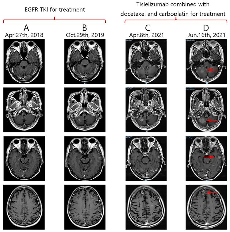 https://cdn.ncbi.nlm.nih.gov/pmc/blobs/c351/12283237/1441ff0d89f8/OTT-18-803-g0003.jpg