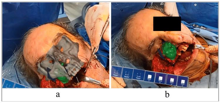 https://cdn.ncbi.nlm.nih.gov/pmc/blobs/c362/11763273/fdf01542abb7/cureus-0016-00000076428-i03.jpg