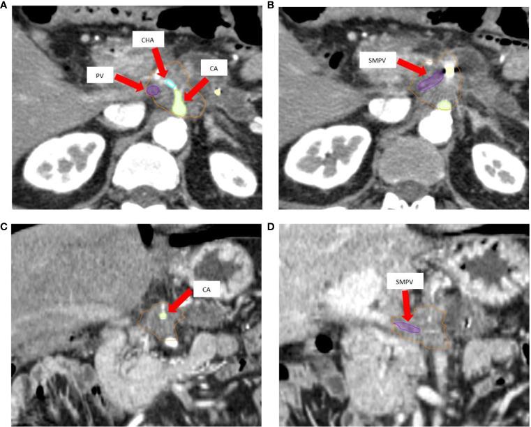 https://cdn.ncbi.nlm.nih.gov/pmc/blobs/c401/7773844/e2049ef2a424/fonc-10-600940-g001.jpg